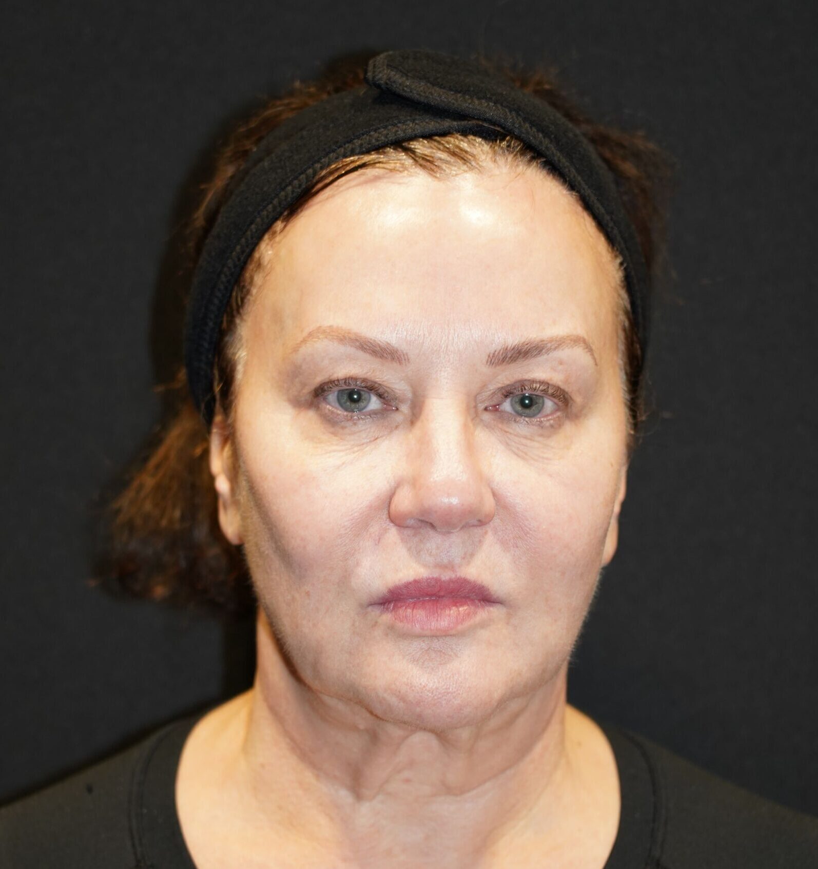 Before photo - 0° view