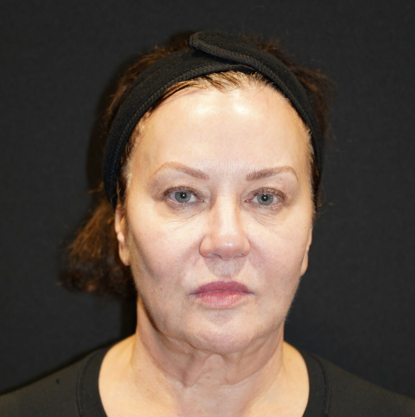 Before photo - 0° view