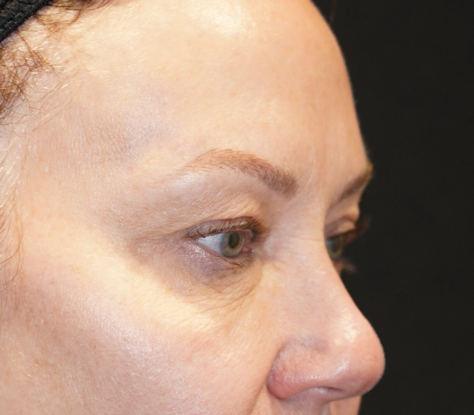 Before photo - 45° view