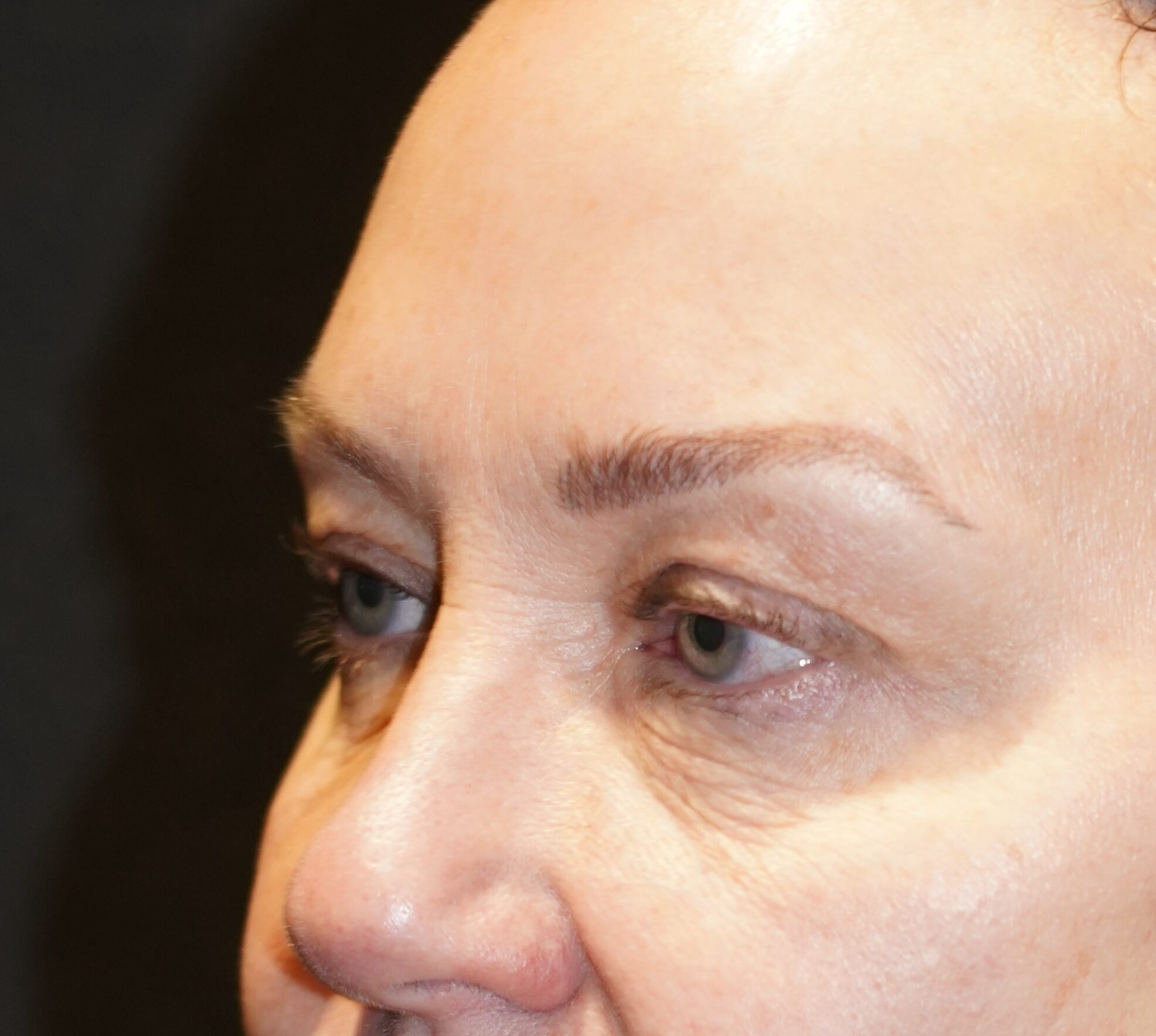 Before photo - -45° view