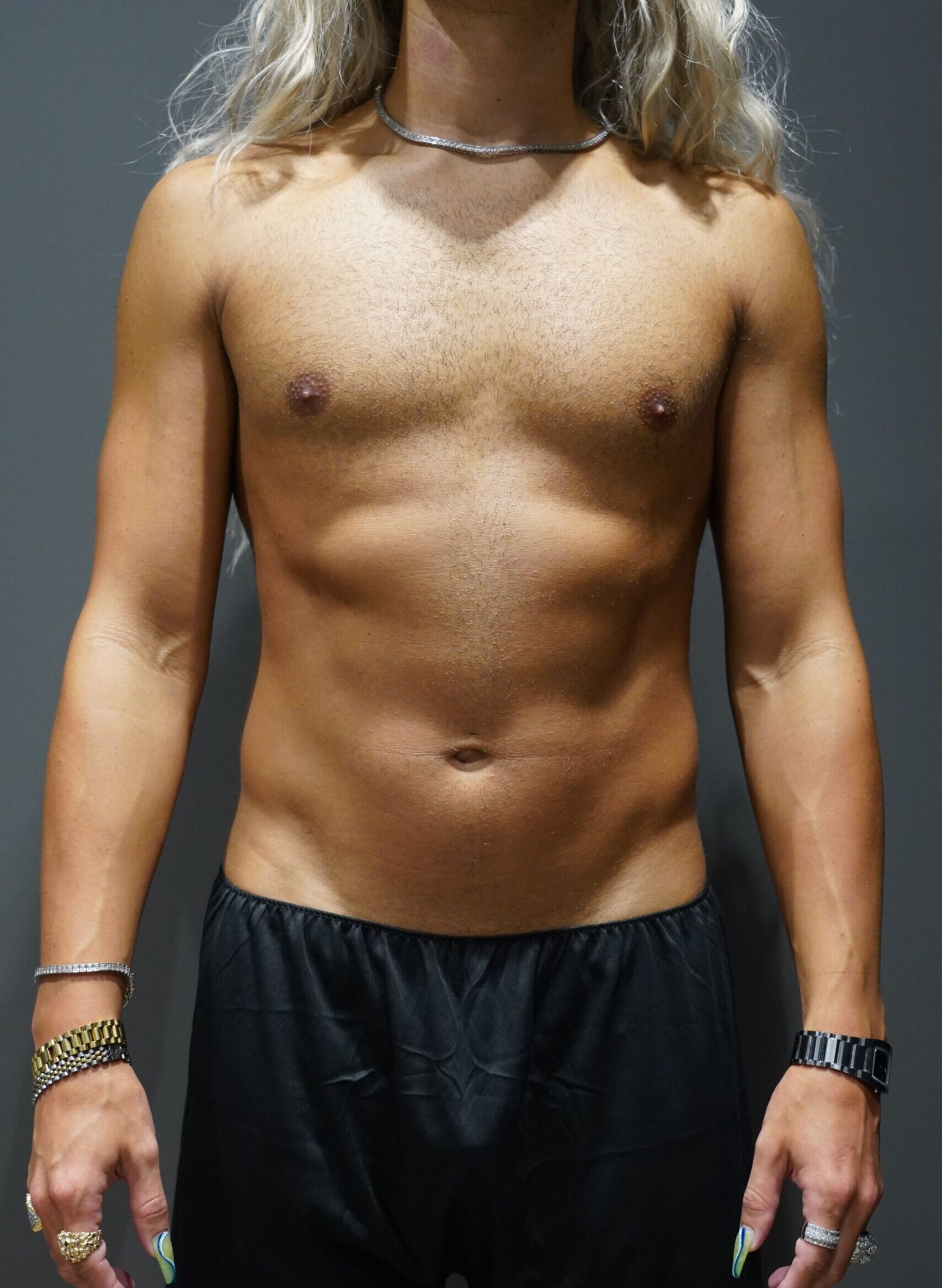 Before photo - 0° view