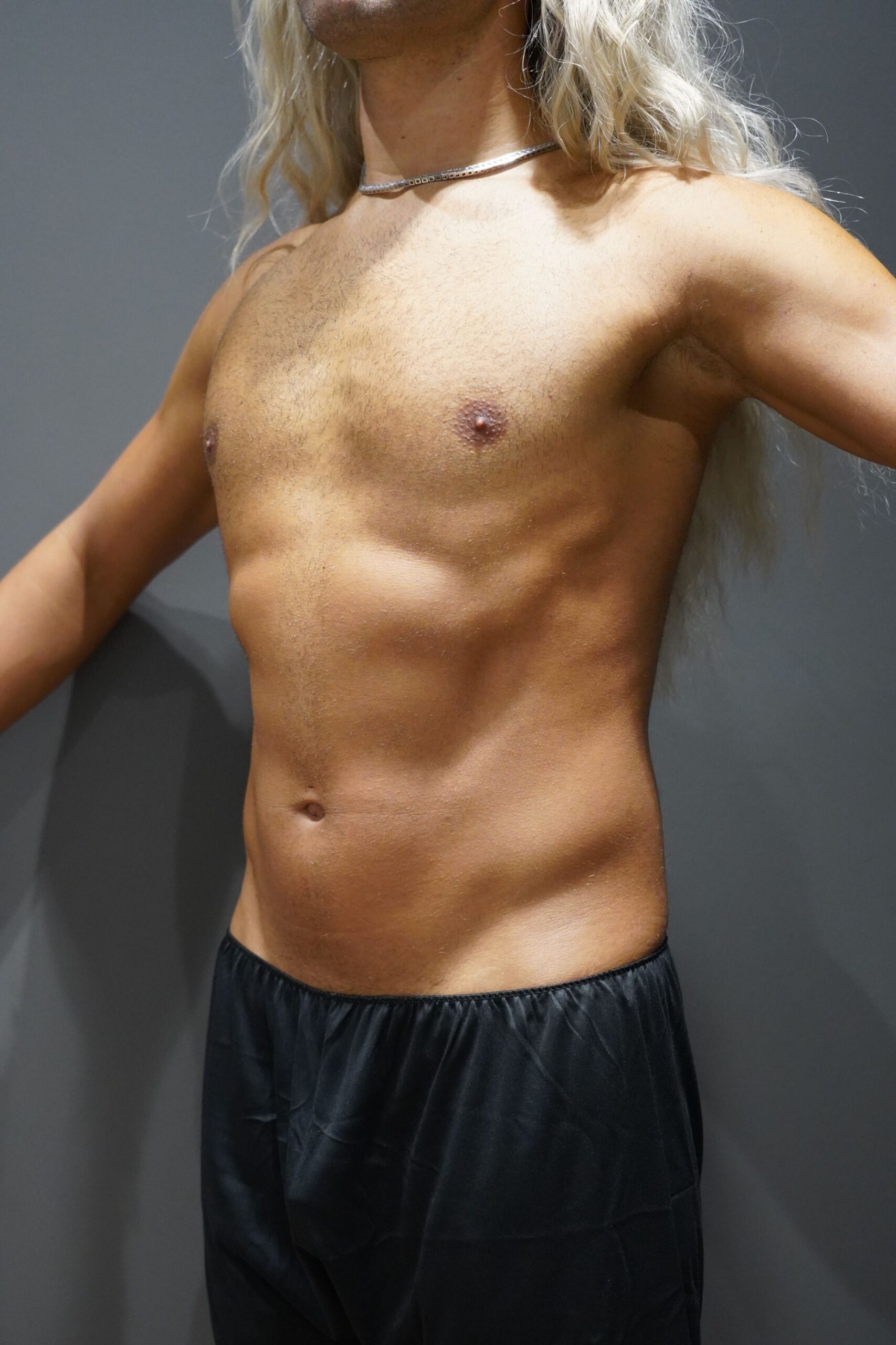 Before photo - -45° view