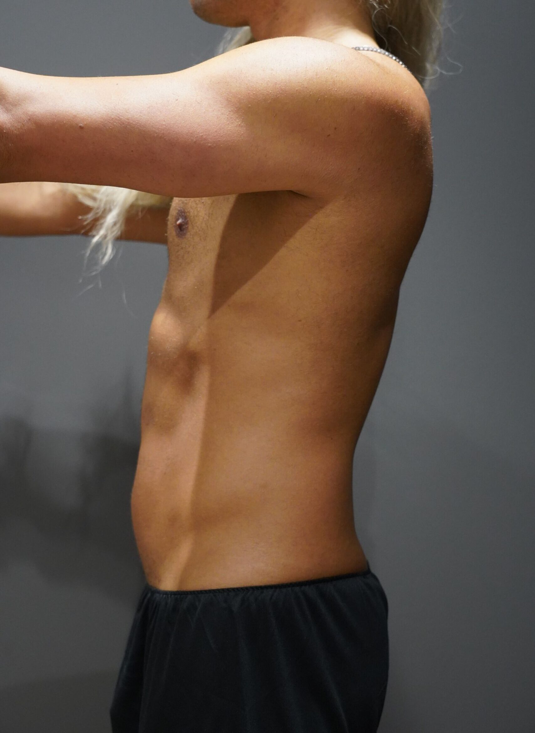 Before photo - -90° view