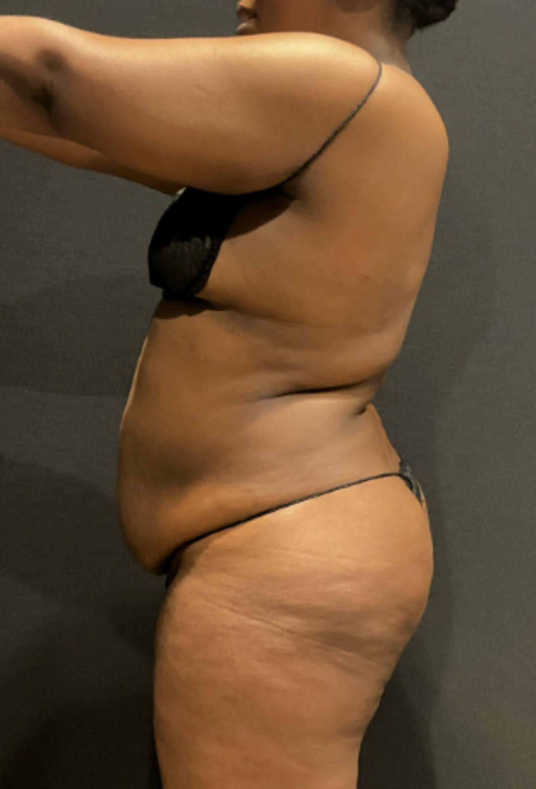 Before photo - -90° view