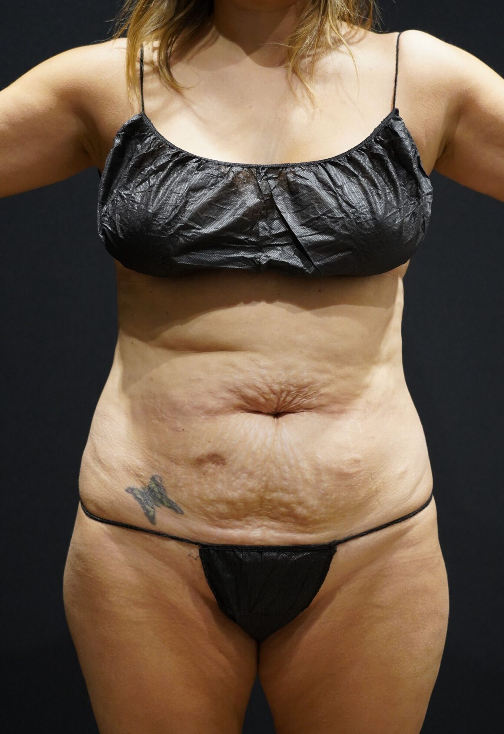 Before photo - 0° view