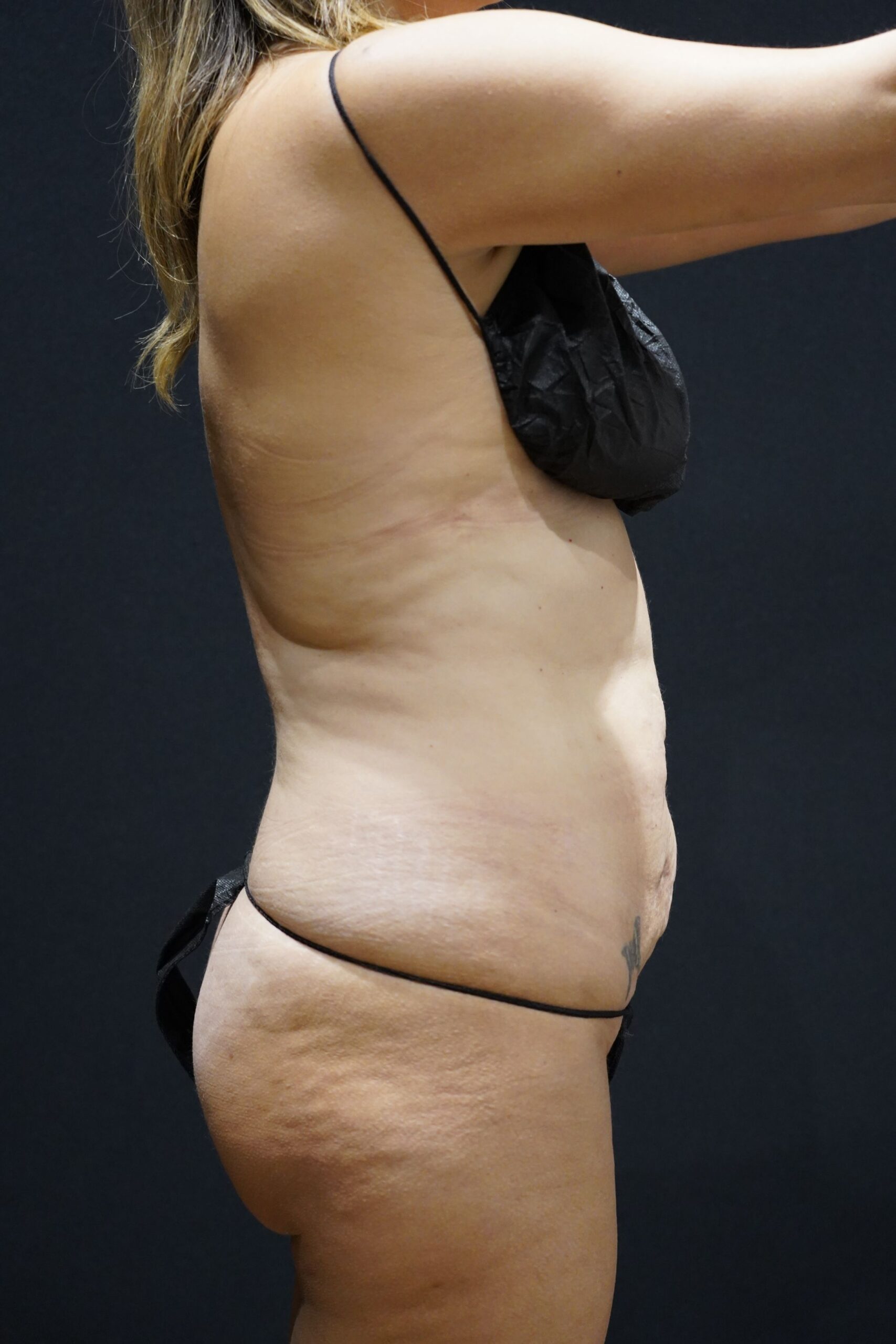 Before photo - 90° view