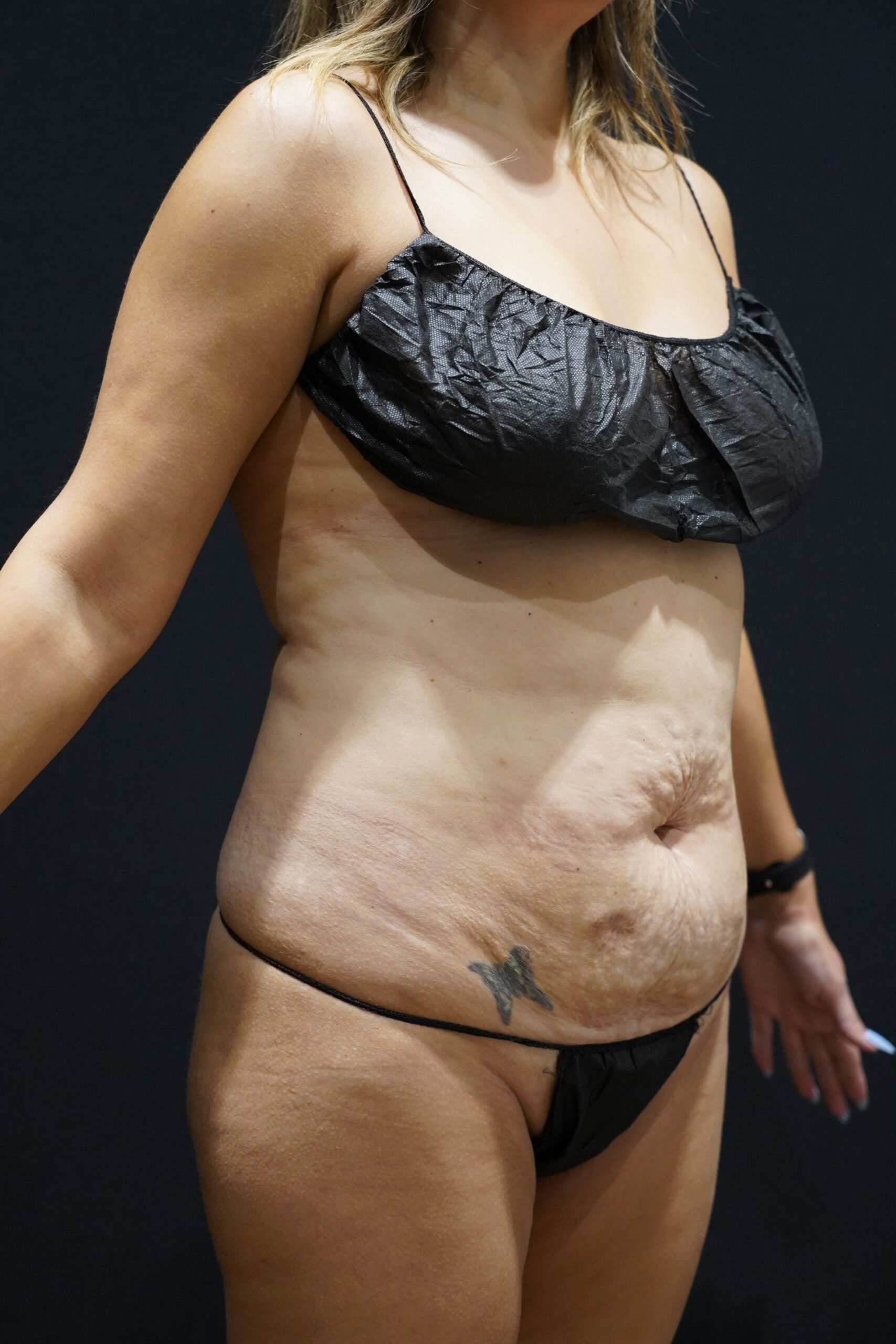 Before photo - 45° view