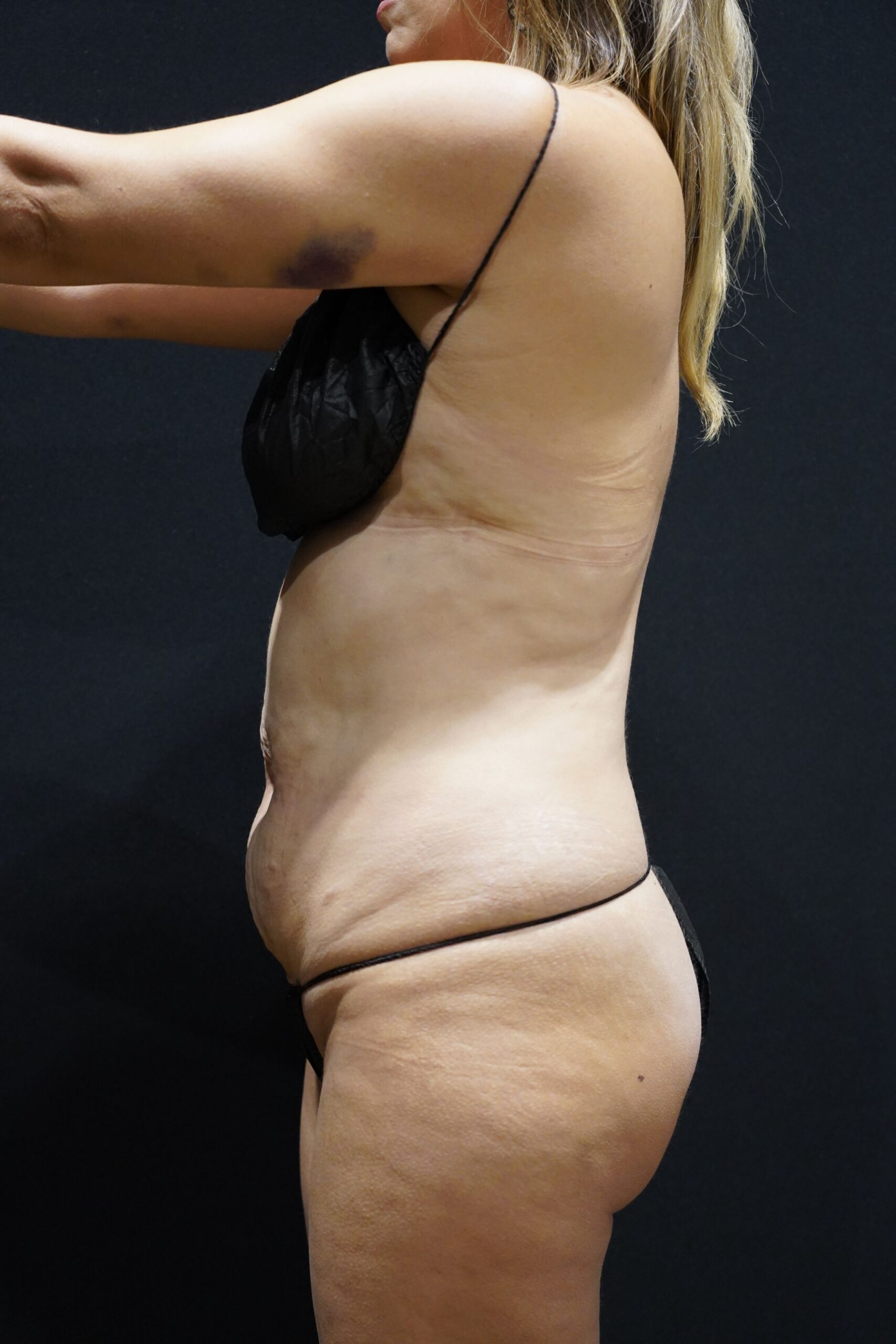 Before photo - -90° view