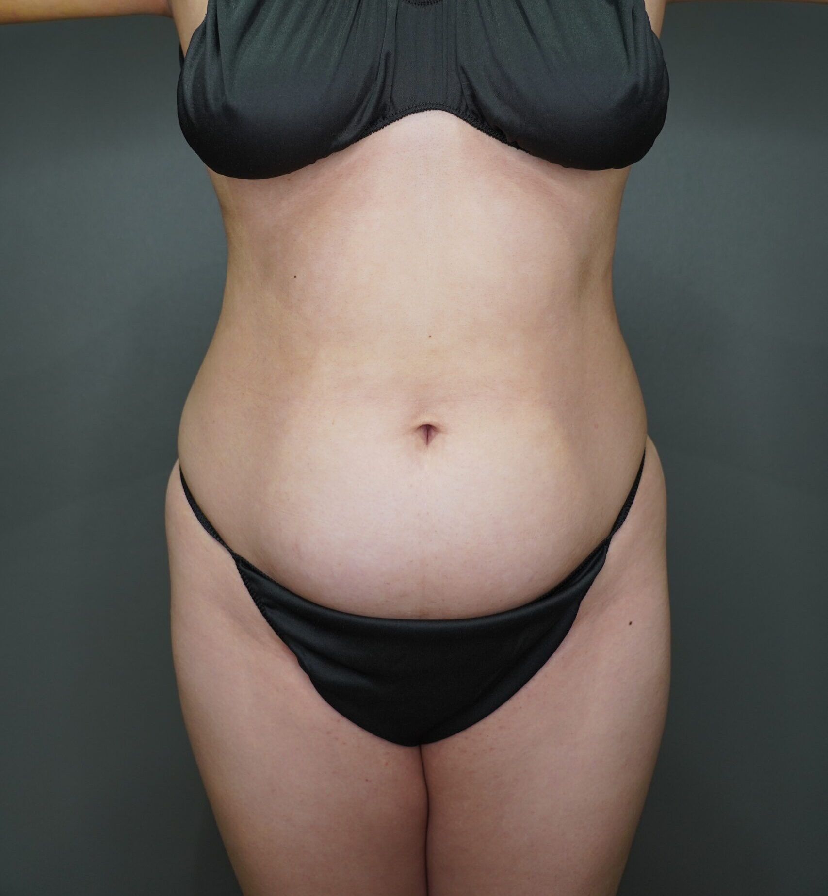 Before photo - 0° view