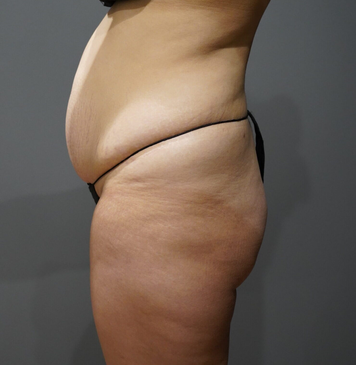 Before photo - -90° view