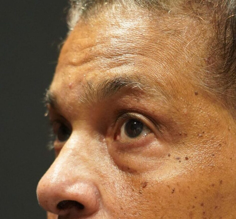 Before photo - -45° view