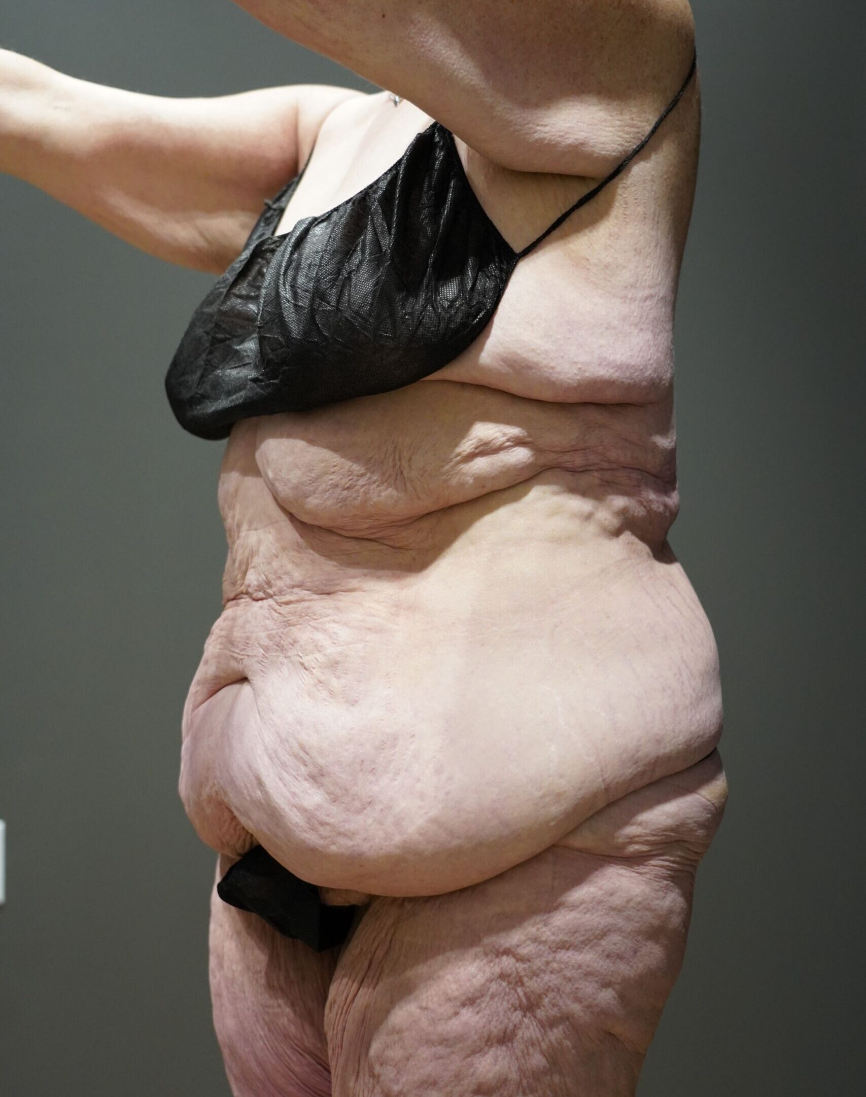 Before photo - -45° view