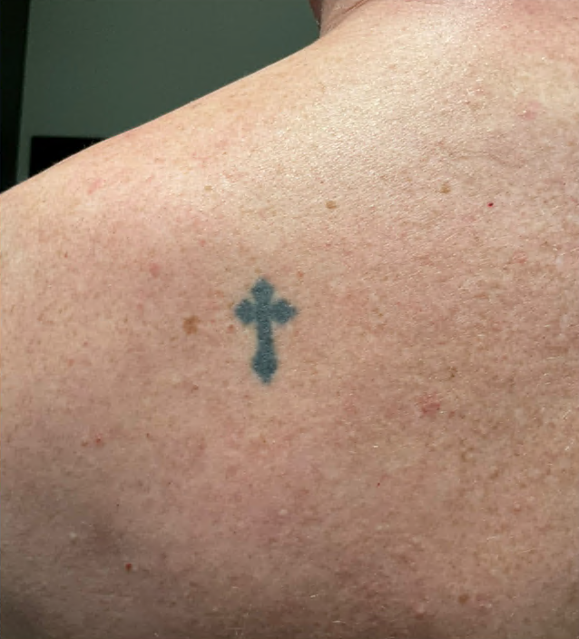 Case--9586 | Before Tattoo Removal